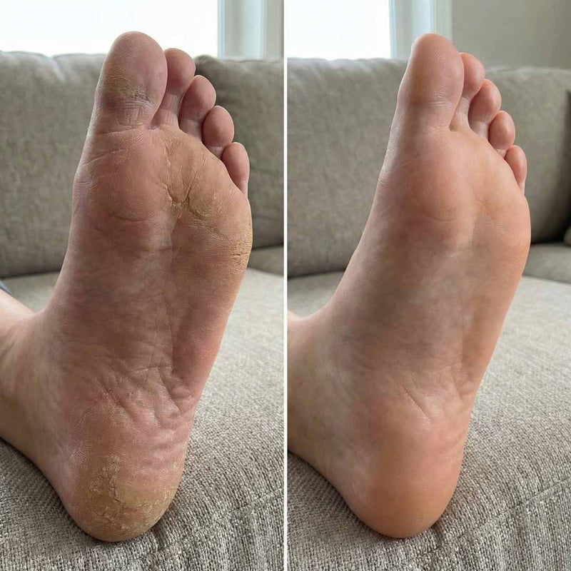 Cali Electric Callus Remover