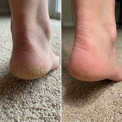 Cali Electric Callus Remover