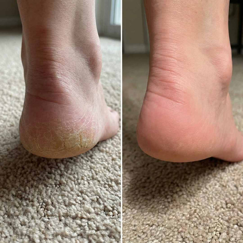 Cali Electric Callus Remover